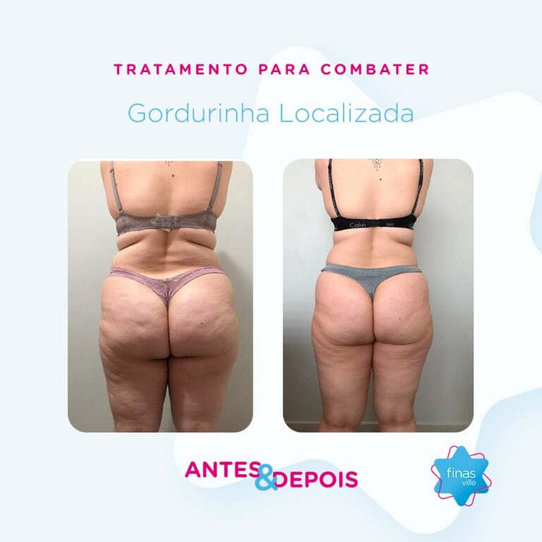 Antes e Depois - Costas