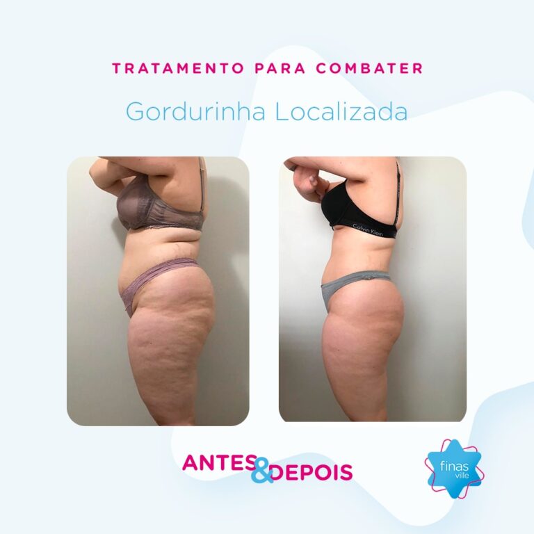 Antes e  Depois - Perfil