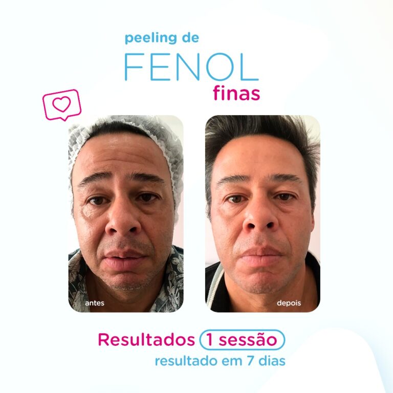 PeelingFinas - Frente